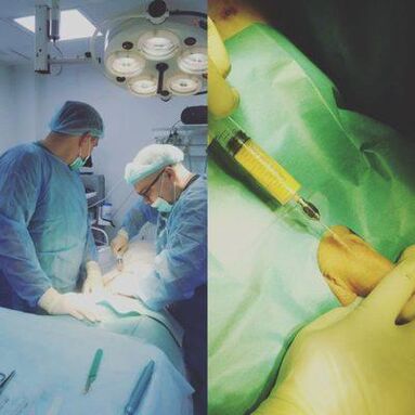 Eine Penisverdickung ist mit Hilfe einer Operation möglich. 